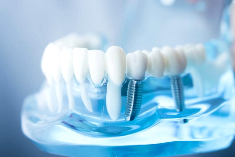 oradent-servicii-implantologie oradent-servicii-implantologie